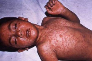 Kid with measles