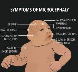 Symptoms of Microcephaly