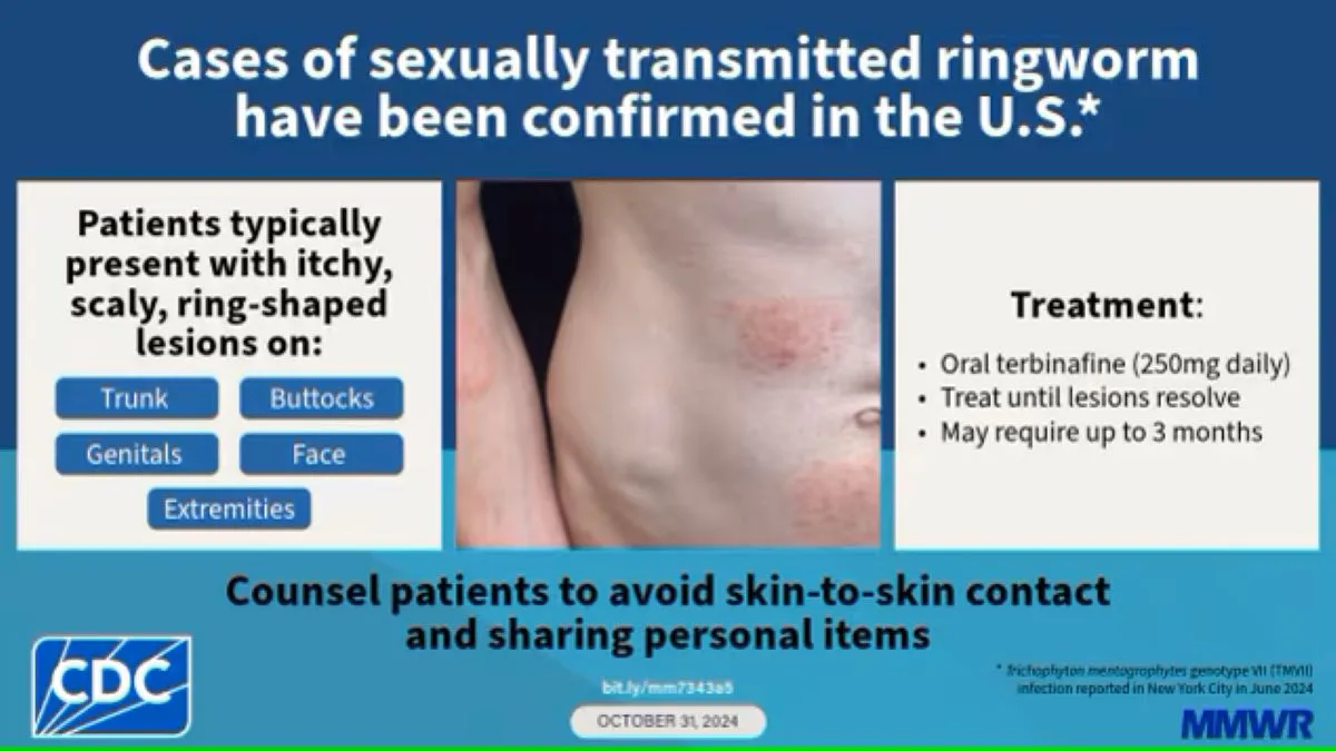 The first case of sexually transmitted ringworm has been identified in Orange County